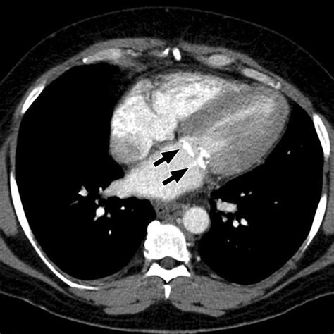 Mdct Detection Of Mitral Valve Calcification Prevalence And Clinical