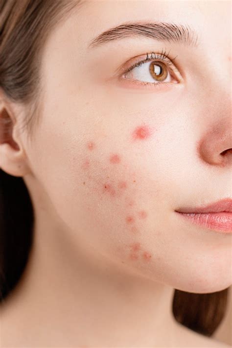 Does Dairy Consumption Cause Acne
