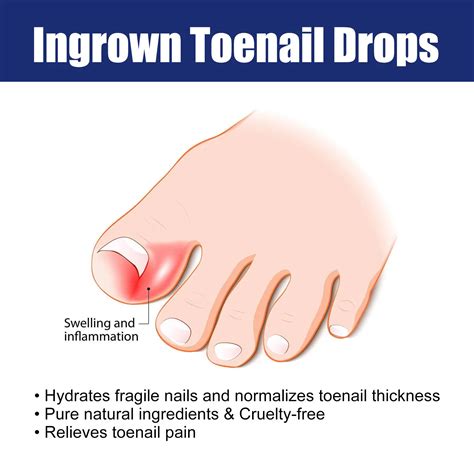West&month Ingrown Toenail Serum - Pain Relief & Softening