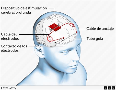 Cómo funciona el dispositivo implantado por primera vez en el mundo en