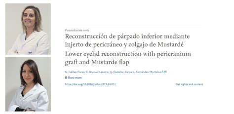 El Dpto De Oculoplastia Publica Un Caso De Reconstrucción De Párpado