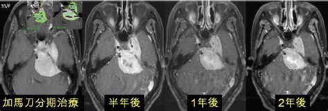 腦瘤 3 5公分可以加馬刀治療