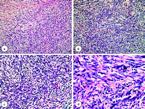 Morphology Of Dermal High Grade Sarcoma Arising In Dermatofibrosarcoma