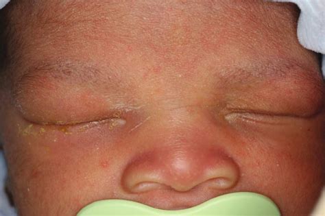 Study Medical Photos: Neonatal Conjunctivitis - A Brief Discussion