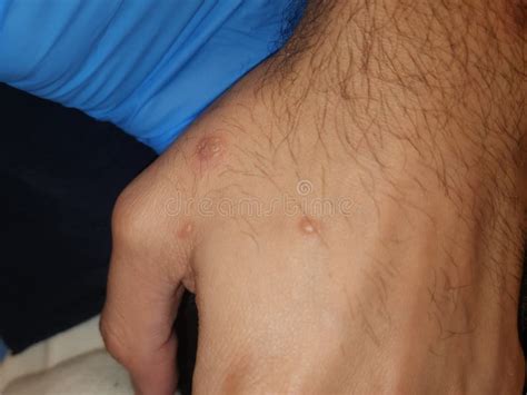 Monkeypox Disseminated Skin Lesions Gay White Male Stock Photo