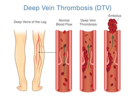 Deep Vein Thrombosis (DVT): Symptoms, Causes, & Treatment