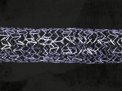 Stent placement: Types, procedures, risks, recovery