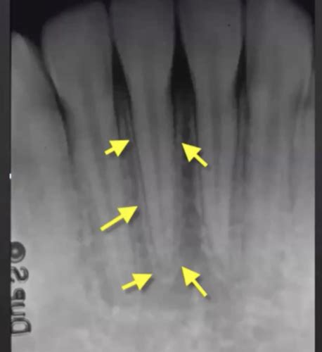 Normal Radiograph Anatomy Intraoral Radiology Flashcards Quizlet