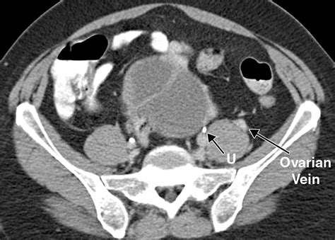 Recognition Of The Ovaries And Ovarian Origin Of Pelvic Masses With Ct