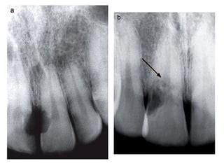 Root Resorption | PPT