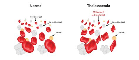 5 Common Thalassaemia Questions | CFCH | Singapore