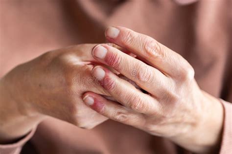 Woman Hands With Atopic Dermatitis Eczema Allergy Reaction On Skin