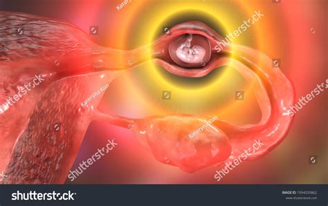 Tubal Ectopic Pregnancy D Illustration Showing Stok Ll Strasyon