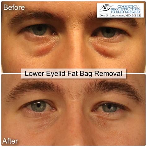 Eye Bag Surgery Lower Lid Blepharoplasty In River Edge Nj