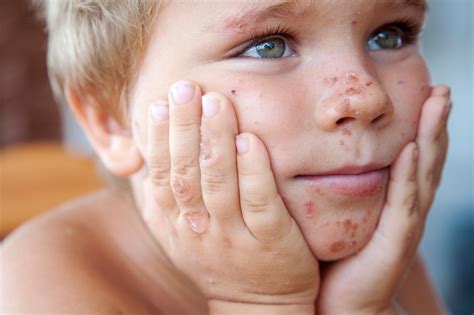 Psoriasis En NiÑos Isbipe