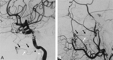 Right ICA A And Right ECA B Angiograms In Lateral View