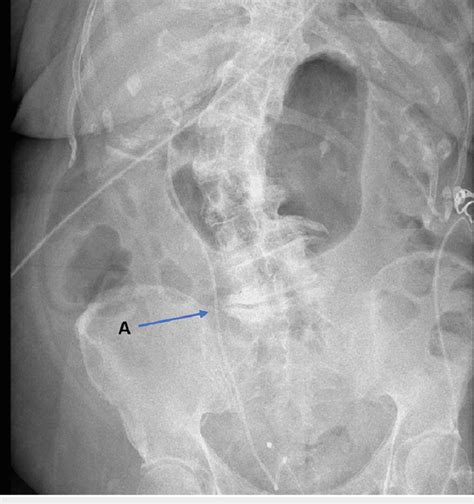 Satisfactory placement of a right-sided ureteric stent (A) on an ...