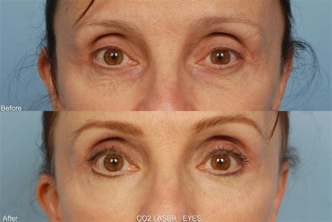 Co2 Laser Resurfacing Before And After Photos Grossman Dermatology