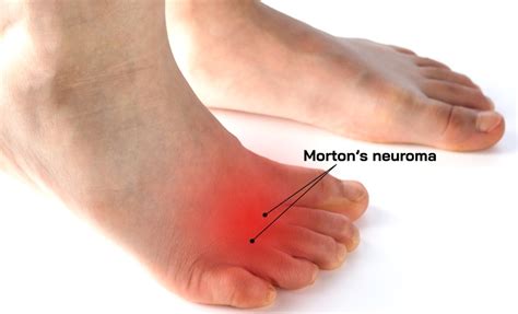 Mortons Neuroma Understanding Causes Symptoms And Treatment