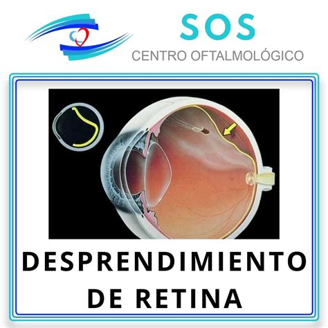 Desprendimiento De Retina Centro Oftalmológico Sos