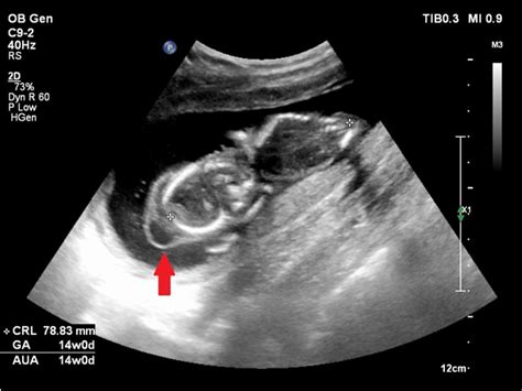 Molar pregnancy – case presentation of 23-year old pregnant women with