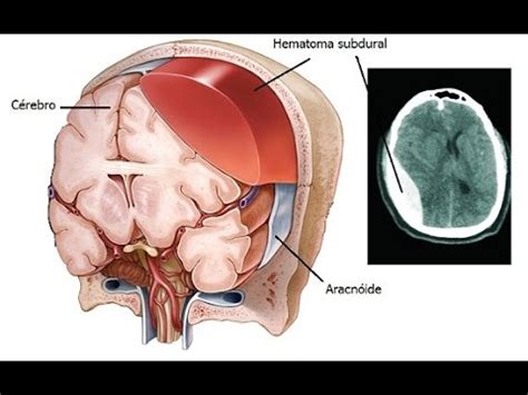 Subdural Hematoma Youtube