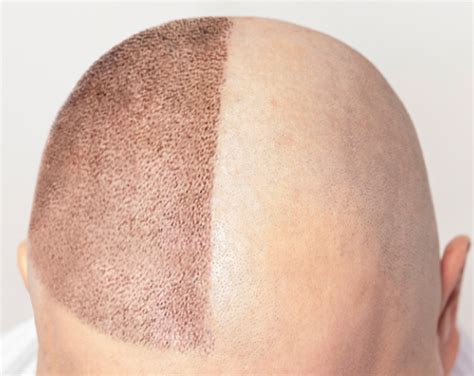 Scalp Micropigmentation Perma Glow Pigments