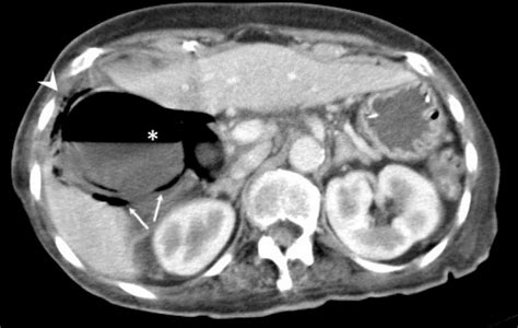 CT Axial View Of The Abdomen Showing An Air Fluid Level Within The