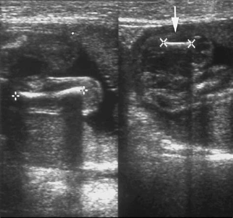 Axial Ultrasound Images Of A 25 Week Fetus Show The Length Discrepancy