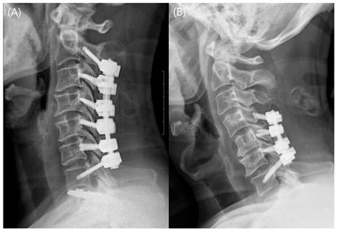 Mechanical Stability and Clinical Outcomes Following Posterior Cervical