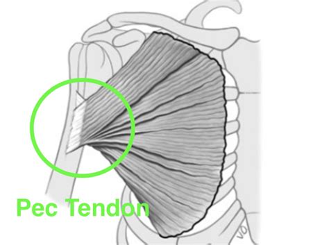 Pectoralis Tendon Tear Dr Edward Weldon