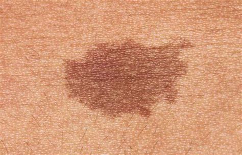 Types Of Birthmarks