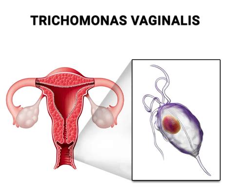 Trichomoniasis Causes Symptoms Testing Treatment