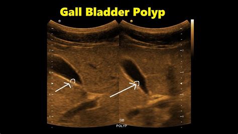 Gallbladder Polyp Ultrasound