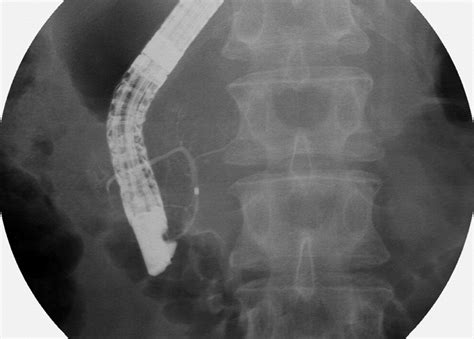 References In Endoscopic Retrograde Pancreatography Clinical