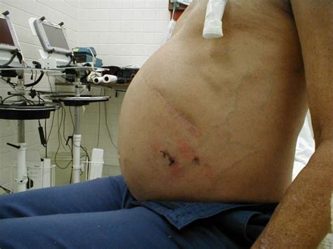 Barriga De Verme Adulto - Sinais De Verme Na Barriga - RETOEDU