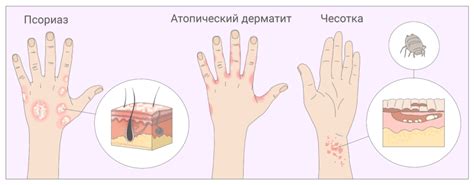 Кожный зуд: всё о причинах, лечении и препаратах