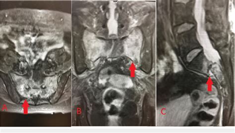 Mri Of The Sacrum And Pelvis A Axial T2 Weighted T2w Short Tau