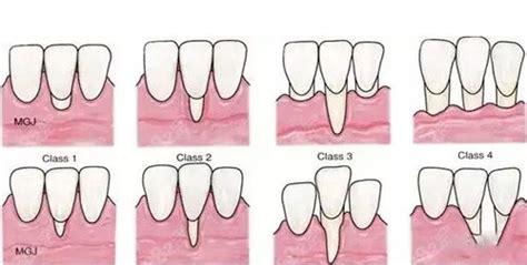 牙龈萎缩各个阶段图片大全三十岁牙龈萎缩还能恢复吗 牙齿对比照片 8682整形网