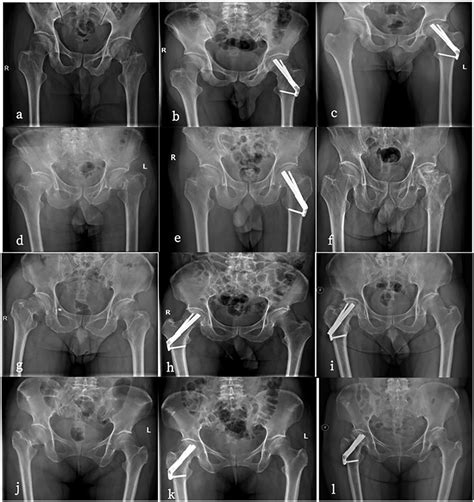 Frontiers | A machine learning model for predicting postoperative