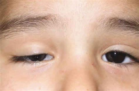 Ptosis Palpebral infantil Oftalmología Avanzada