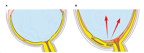 Figure E The Schematic Of Hypodense Regions In Peripapillary With The