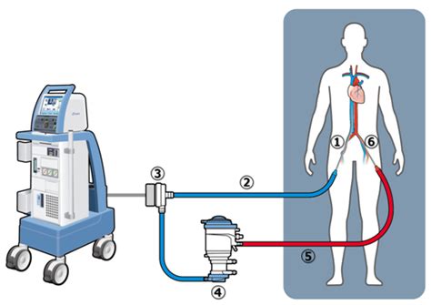 ecmo mera