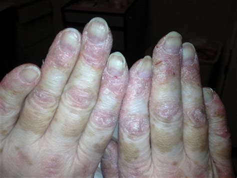 Dermatomyositis Myositis Support And Understanding 59 Off