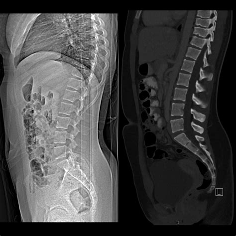 Scheuermann Disease | Pediatric Radiology Reference Article | Pediatric ...