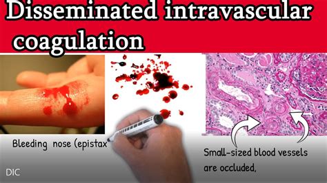 disseminated intravascular coagulation dic  symptoms