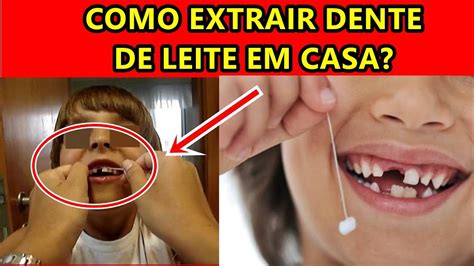 Como Extrair Dente De Leite Em Casa Youtube