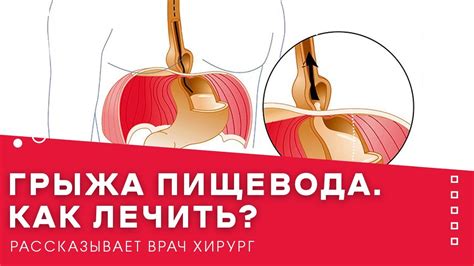 Грыжа Бохдалека: симтомы, диагностика, лечение, вид на КТ и видео