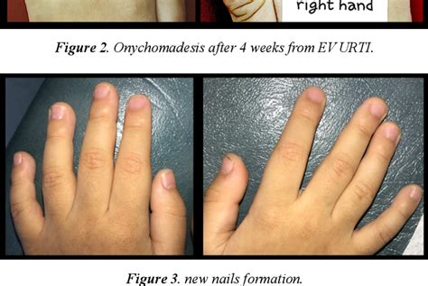 Onychomadesis Secondary To Hand Foot And Mouth Disease