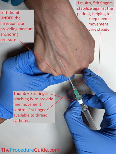 How To Start Peripheral Iv - Ademploy19
